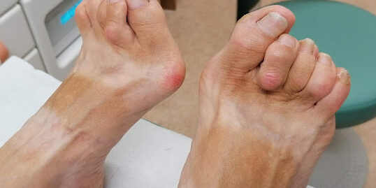 A pair of feet with bunions, corns and calluses